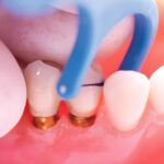 Directa SpotIt Dental Crown & Bridge Contact Finders Angled 18/Pk - Image 2